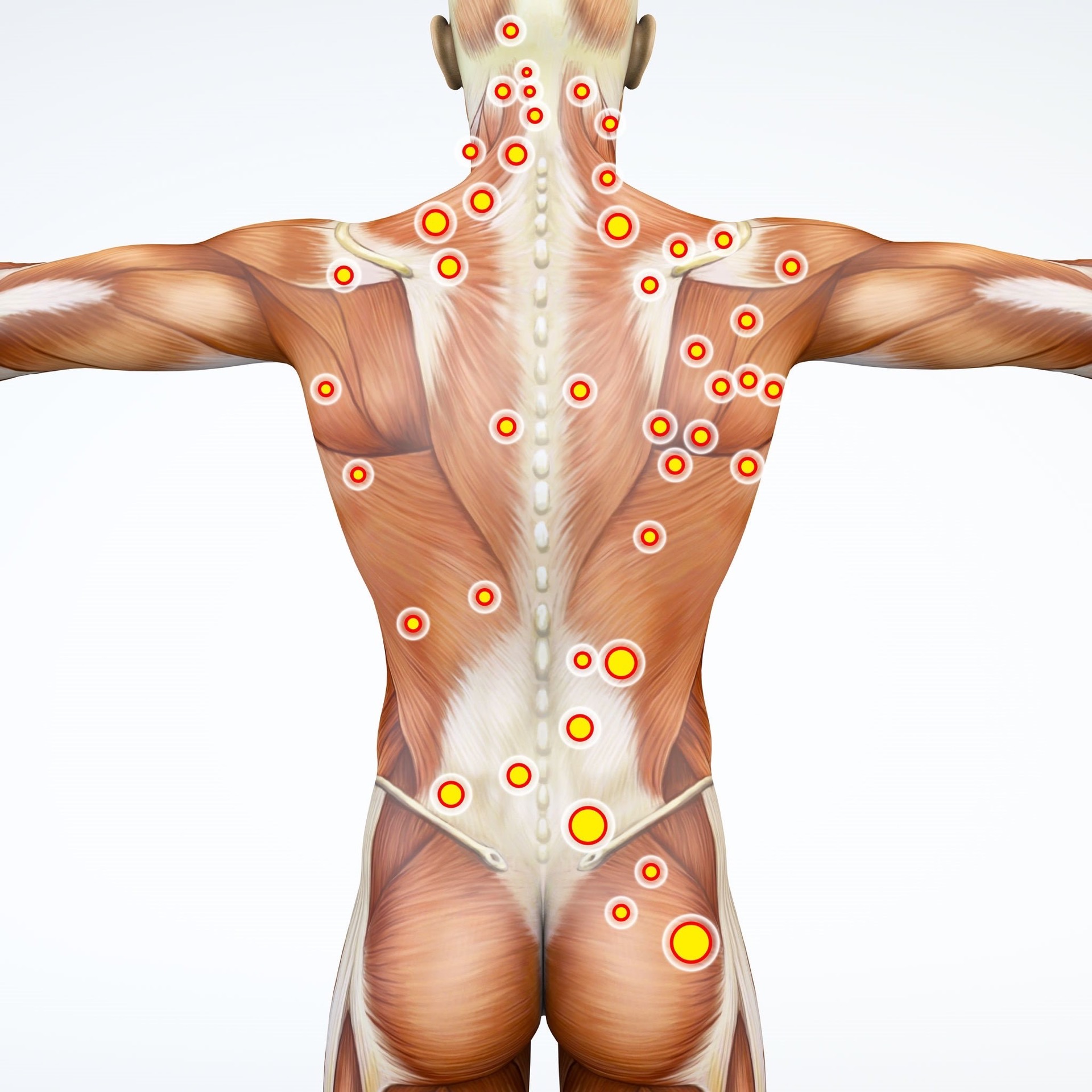 Trigger point terapia